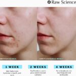 The Best Anti-Acne Supplement for Clear Skin: My Personal Review of S Raw Science Skin Cleanse