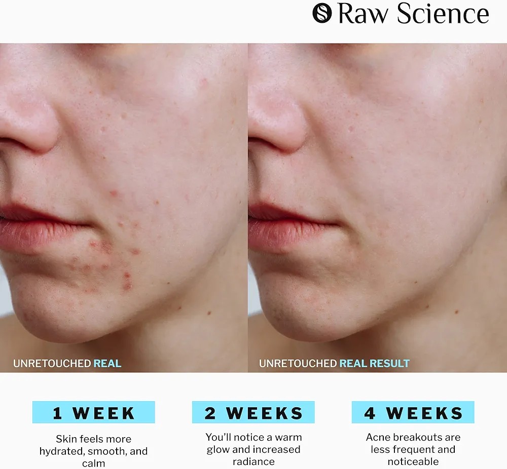 The Best Anti-Acne Supplement for Clear Skin: My Personal Review of S Raw Science Skin Cleanse